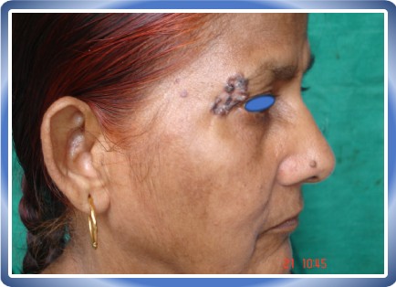 BASAL CELL CARCINOMA